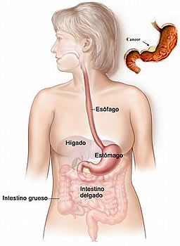 Cáncer gástrico